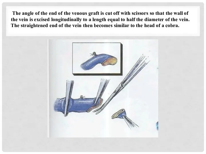 The angle of the end of the venous graft is cut