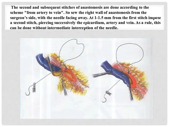 The second and subsequent stitches of anastomosis are done according to