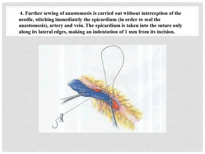 4. Further sewing of anastomosis is carried out without interception of