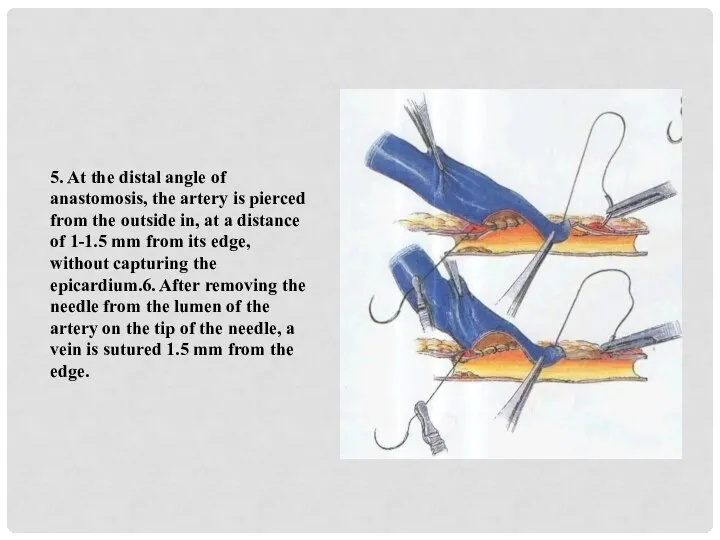 5. At the distal angle of anastomosis, the artery is pierced