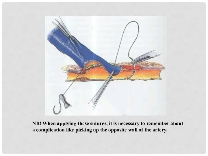 NB! When applying these sutures, it is necessary to remember about