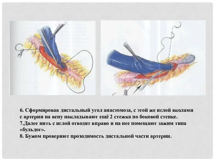 6. Сформировав дистальный угол анастомоза, с этой же иглой вколами с