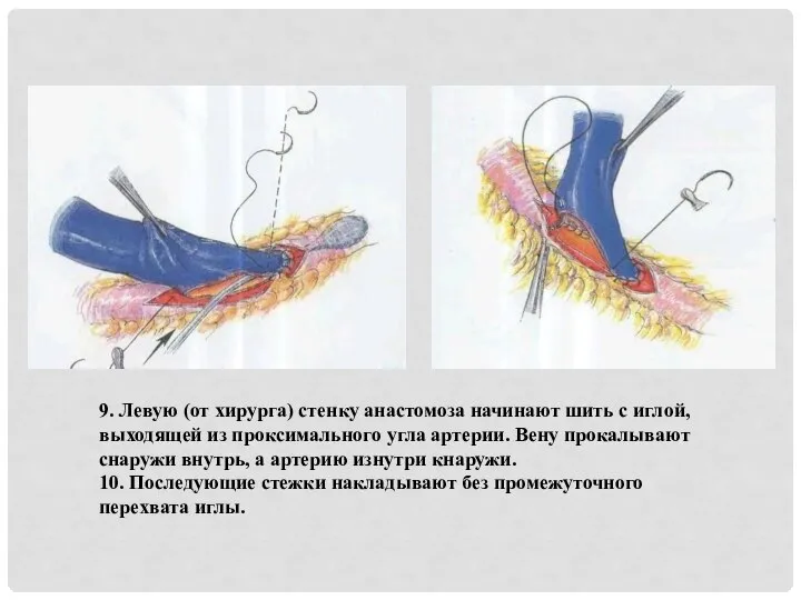 9. Левую (от хирурга) стенку анастомоза начинают шить с иглой, выходящей