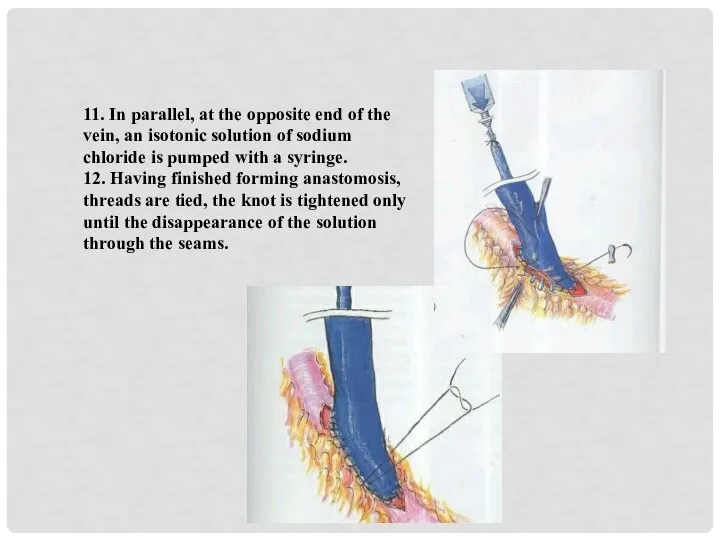 11. In parallel, at the opposite end of the vein, an