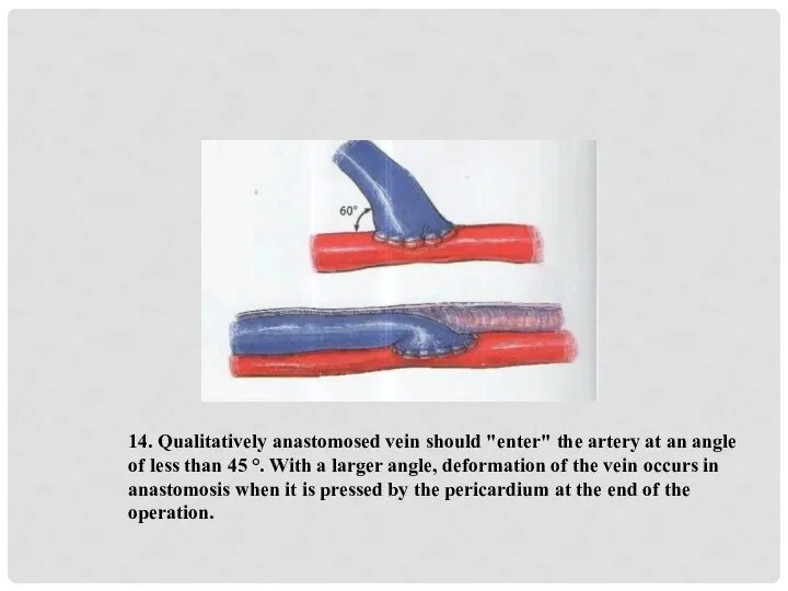 14. Qualitatively anastomosed vein should "enter" the artery at an angle