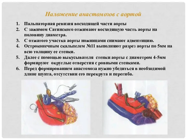 Наложение анастомозов с аортой Пальпаторная ревизия восходящей части аорты С зажимом