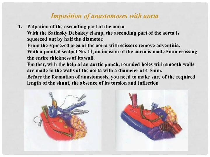 Imposition of anastomoses with aorta Palpation of the ascending part of