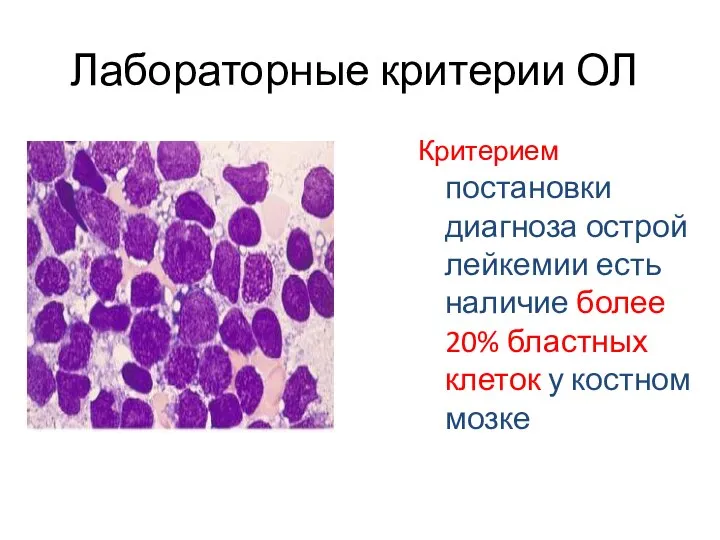 Лабораторные критерии ОЛ Критерием постановки диагноза острой лейкемии есть наличие более