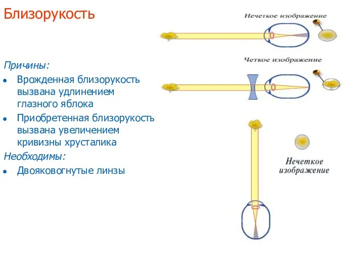 Близорукость Причины: Врожденная близорукость вызвана удлинением глазного яблока Приобретенная близорукость вызвана