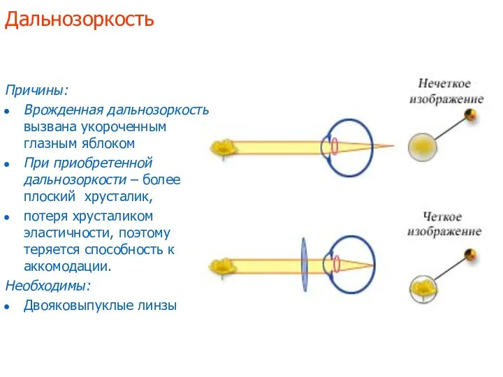 Дальнозоркость Причины: Врожденная дальнозоркость вызвана укороченным глазным яблоком При приобретенной дальнозоркости