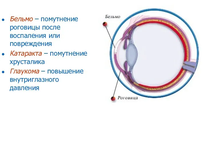 Бельмо – помутнение роговицы после воспаления или повреждения Катаракта – помутнение