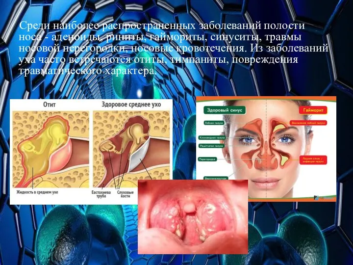 Среди наиболее распространенных заболеваний полости носа - аденоиды, риниты, гаймориты, синуситы,