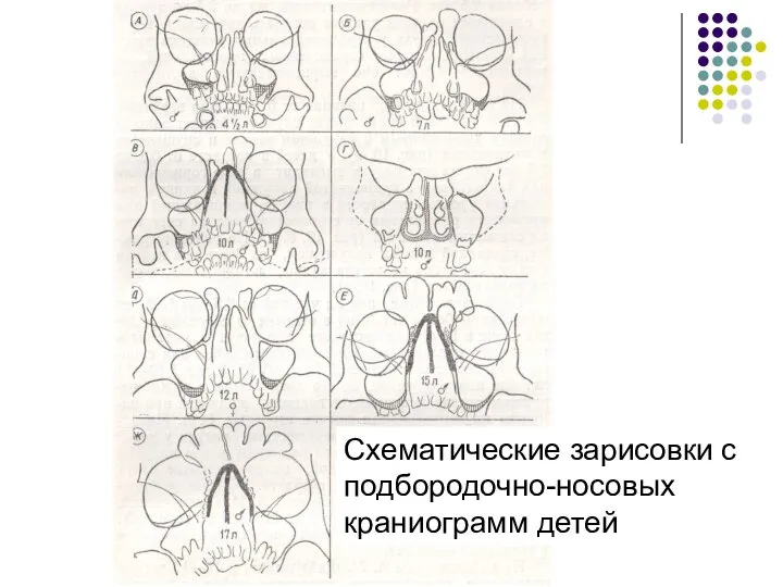 Схематические зарисовки с подбородочно-носовых краниограмм детей