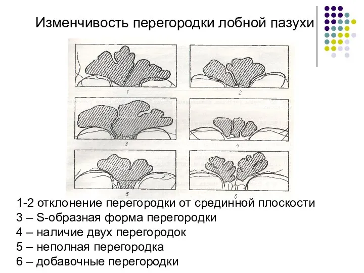 Изменчивость перегородки лобной пазухи 1-2 отклонение перегородки от срединной плоскости 3