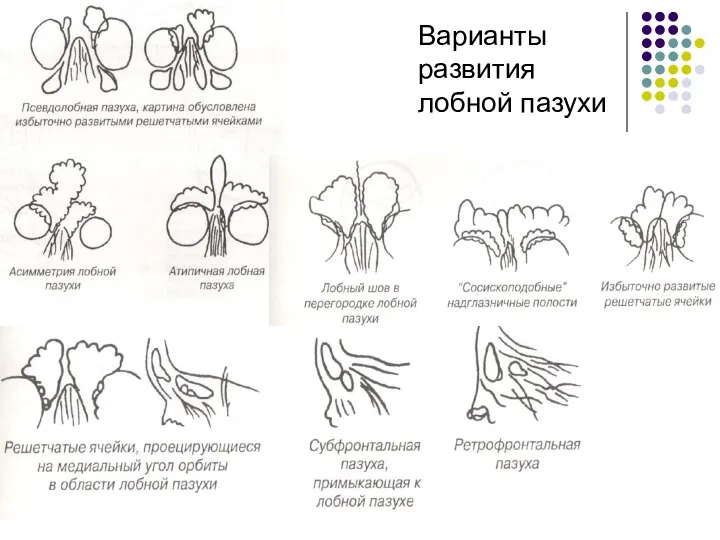 Варианты развития лобной пазухи