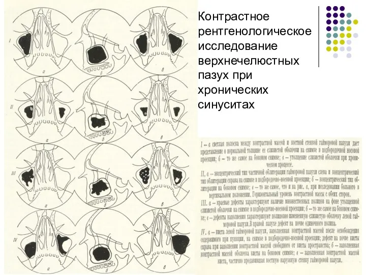 Контрастное рентгенологическое исследование верхнечелюстных пазух при хронических синуситах