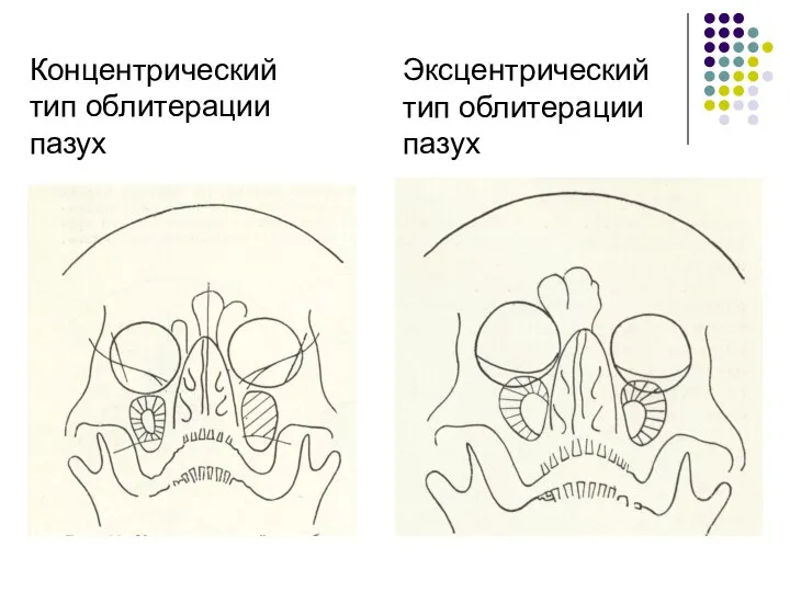 Концентрический тип облитерации пазух Эксцентрический тип облитерации пазух