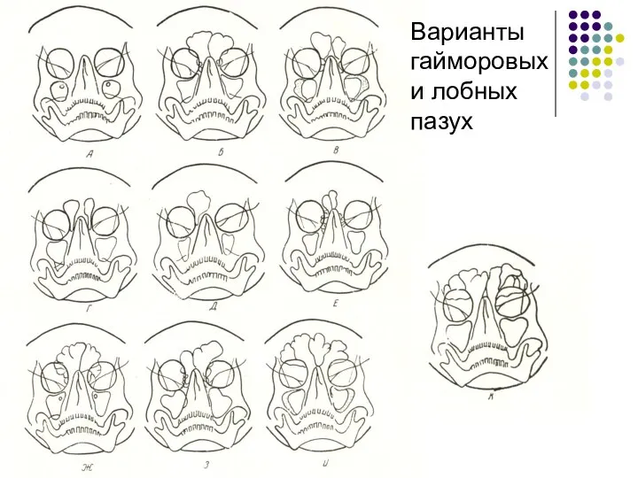 Варианты гайморовых и лобных пазух