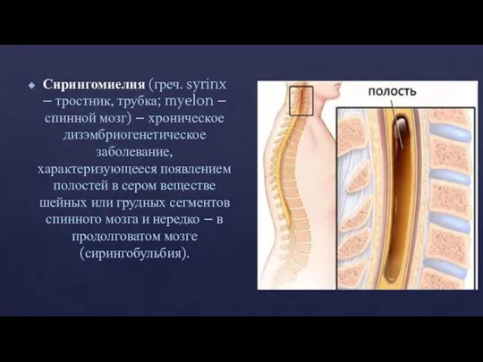 Сирингомиелия (греч. syrinx – тростник, трубка; myelon – спинной мозг) –