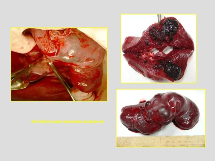 Нестабильная гематома селезенки