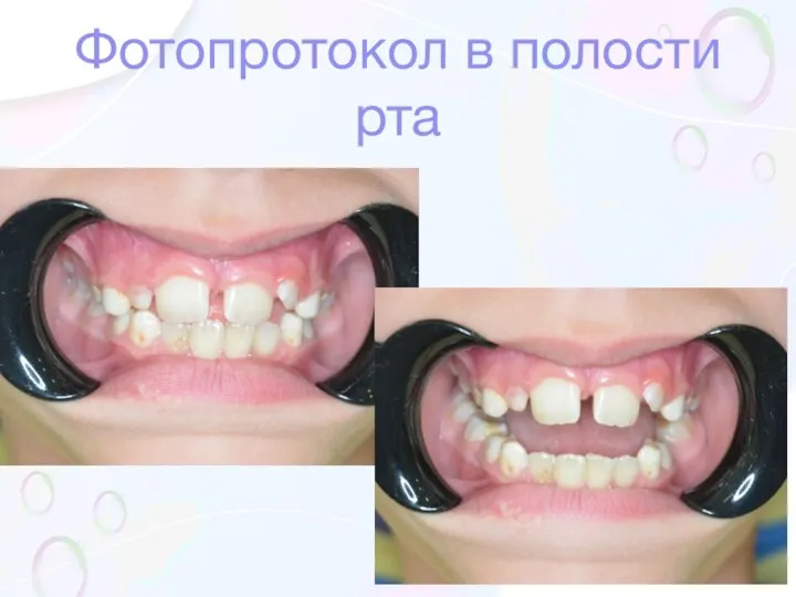 Фотопротокол в полости рта