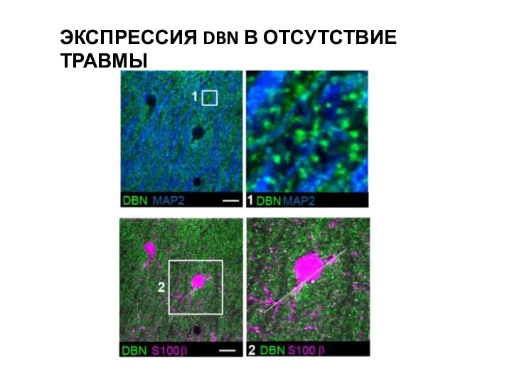 ЭКСПРЕССИЯ DBN В ОТСУТСТВИЕ ТРАВМЫ