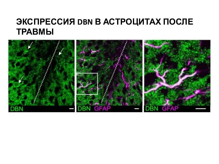 ЭКСПРЕССИЯ DBN В АСТРОЦИТАХ ПОСЛЕ ТРАВМЫ