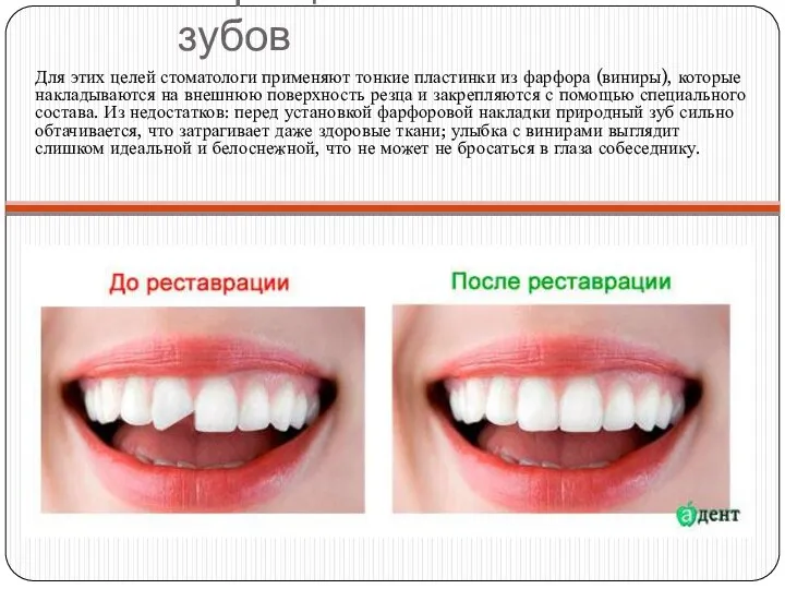 Наращивание зубов Для этих целей стоматологи применяют тонкие пластинки из фарфора