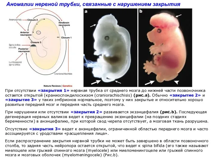 Аномалии нервной трубки, связанные с нарушением закрытия При отсутствии «закрытия 1»