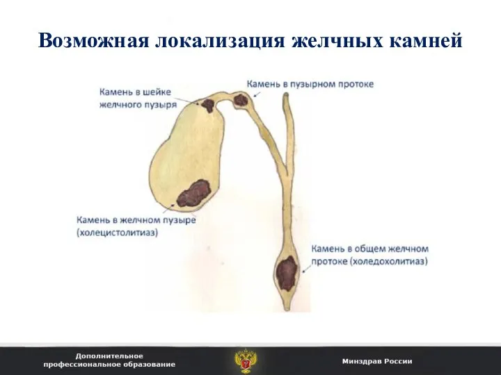 Возможная локализация желчных камней