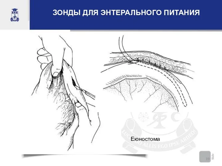 Еюностома ЗОНДЫ ДЛЯ ЭНТЕРАЛЬНОГО ПИТАНИЯ