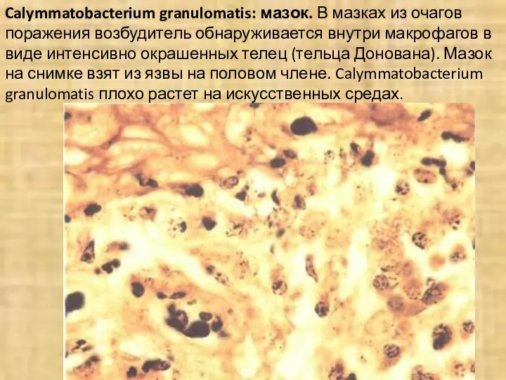 Calymmatobacterium granulomatis: мазок. В мазках из очагов поражения возбудитель обнаруживается внутри