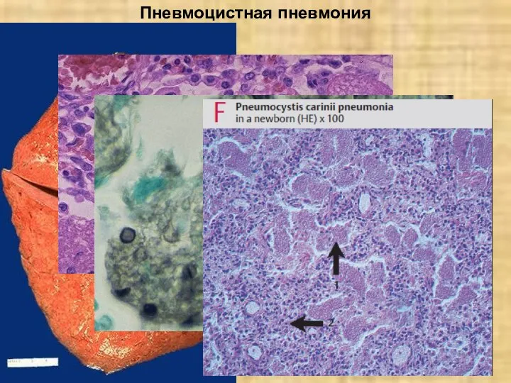 Пневмоцистная пневмония