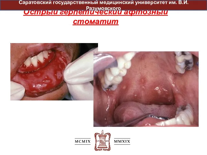 Острый герпетический афтозный стоматит Саратовский государственный медицинский университет им. В.И. Разумовского