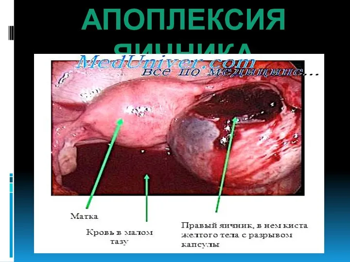 АПОПЛЕКСИЯ ЯИЧНИКА