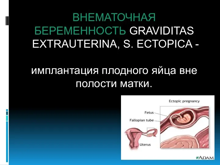 ВНЕМАТОЧНАЯ БЕРЕМЕННОСТЬ GRAVIDITAS EXTRAUTERINA, S. ECTOPICA - имплантация плодного яйца вне полости матки.