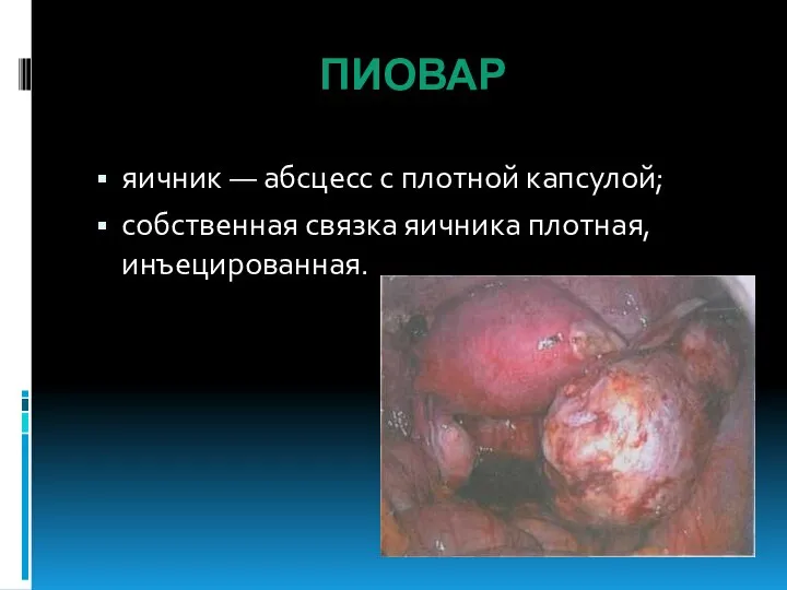 ПИОВАР яичник — абсцесс с плотной капсулой; собственная связка яичника плотная, инъецированная.