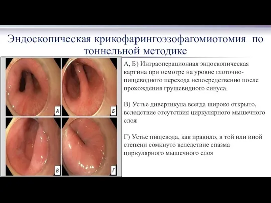 Эндоскопическая крикофарингоэзофагомиотомия по тоннельной методике А, Б) Интраоперационная эндоскопическая картина при