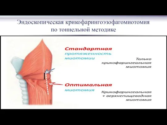 Эндоскопическая крикофарингоэзофагомиотомия по тоннельной методике