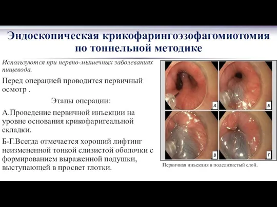 Используются при нервно-мышечных заболеваниях пищевода. Перед операцией проводится первичный осмотр .