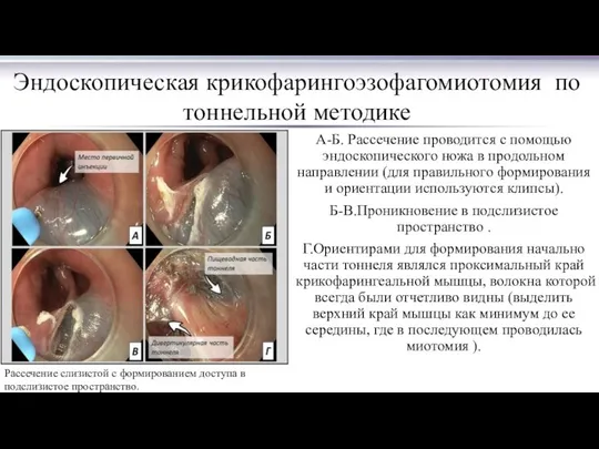 А-Б. Рассечение проводится с помощью эндоскопического ножа в продольном направлении (для