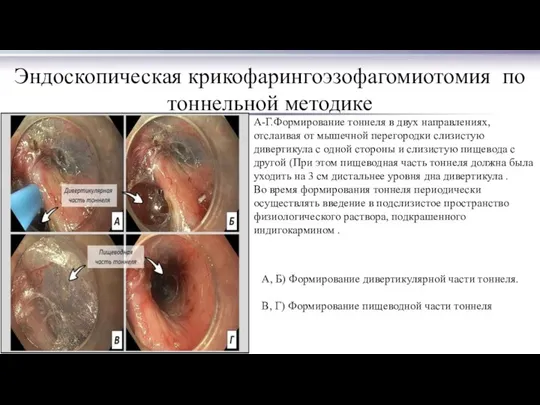 Эндоскопическая крикофарингоэзофагомиотомия по тоннельной методике А-Г.Формирование тоннеля в двух направлениях, отслаивая