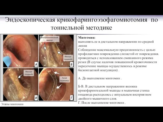 Эндоскопическая крикофарингоэзофагомиотомия по тоннельной методике Этапы миотомии Миотомия: выполнять ее в