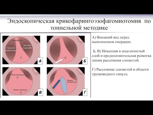 Эндоскопическая крикофарингоэзофагомиотомия по тоннельной методике А) Внешний вид перед выполнением операции.