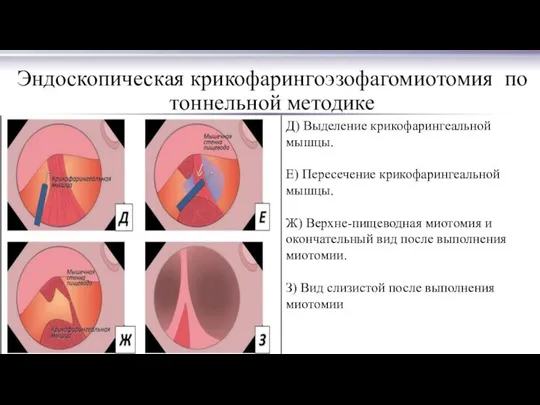 Эндоскопическая крикофарингоэзофагомиотомия по тоннельной методике Д) Выделение крикофарингеальной мышцы. Е) Пересечение