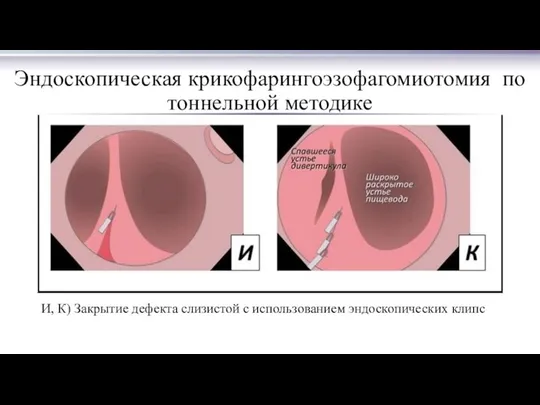 Эндоскопическая крикофарингоэзофагомиотомия по тоннельной методике И, К) Закрытие дефекта слизистой с использованием эндоскопических клипс