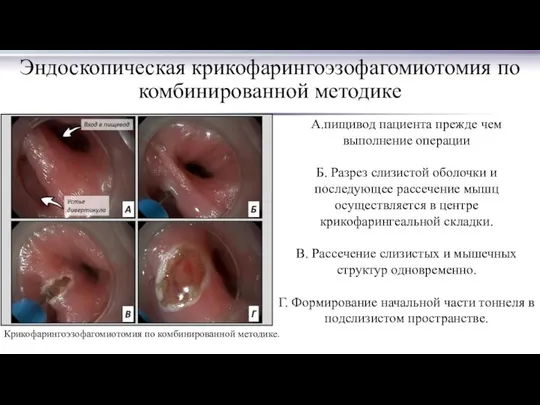 Эндоскопическая крикофарингоэзофагомиотомия по комбинированной методике Крикофарингоэзофагомиотомия по комбинированной методике. А.пищивод пациента