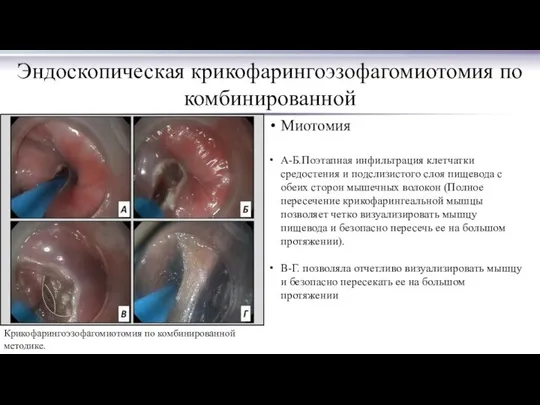 Эндоскопическая крикофарингоэзофагомиотомия по комбинированной Крикофарингоэзофагомиотомия по комбинированной методике. Миотомия А-Б.Поэтапная инфильтрация
