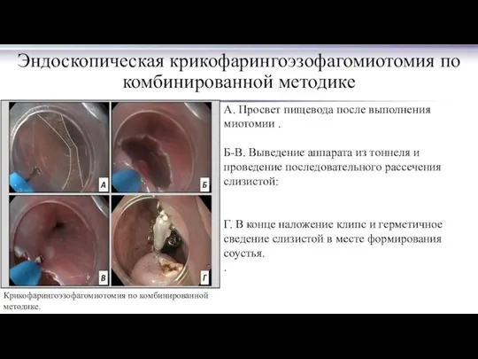 Эндоскопическая крикофарингоэзофагомиотомия по комбинированной методике Крикофарингоэзофагомиотомия по комбинированной методике. А. Просвет