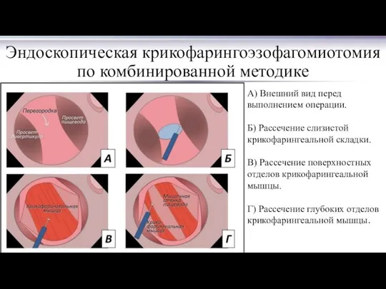 Эндоскопическая крикофарингоэзофагомиотомия по комбинированной методике А) Внешний вид перед выполнением операции.